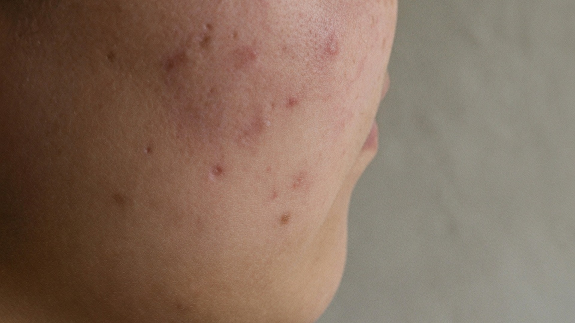 Acne Treatment Programs treatment at Laser Aesthetics in Burlington, Ontario